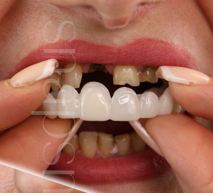  لمینت دندان دو فک اصلی برای خرابی 6 دندان vision6 دکترفروش